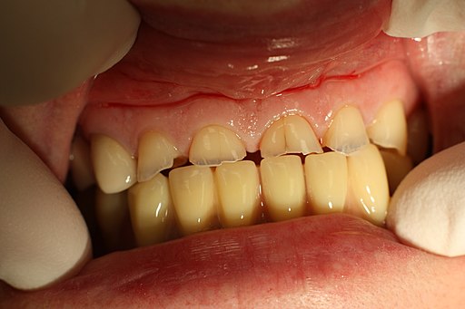 Dental abrasion 20100113 005