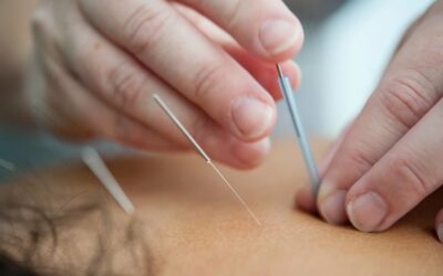 Acupuncture May Help Alleviate Osteoarthritis Pain