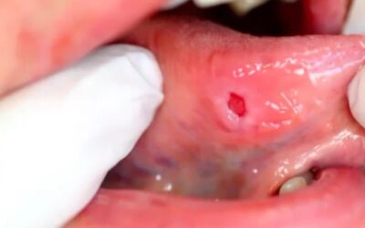 Oral Pathology of Traumatic Ulcerative Granuloma and TUGSE