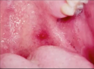 Minor Apthous Ulcer in the Mouth