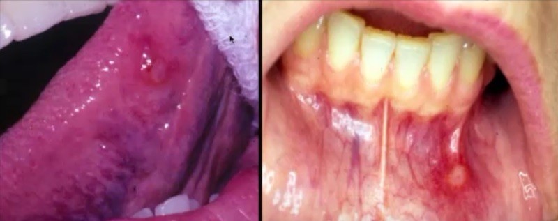 Picture of an Apthous Ulcer on the tounge and mandibular fold.
