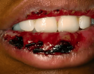oral ulcerative lesions