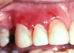 Pemphigoid Picture of the Oral Cavity