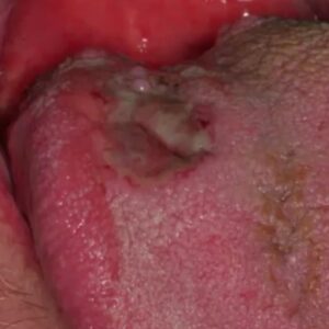 dorsal tongue lesion pictures deep fungal infection