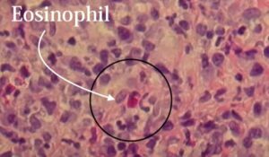 Eosinophils in an oral aphthous ulcer in a patient with Crohn's Disease