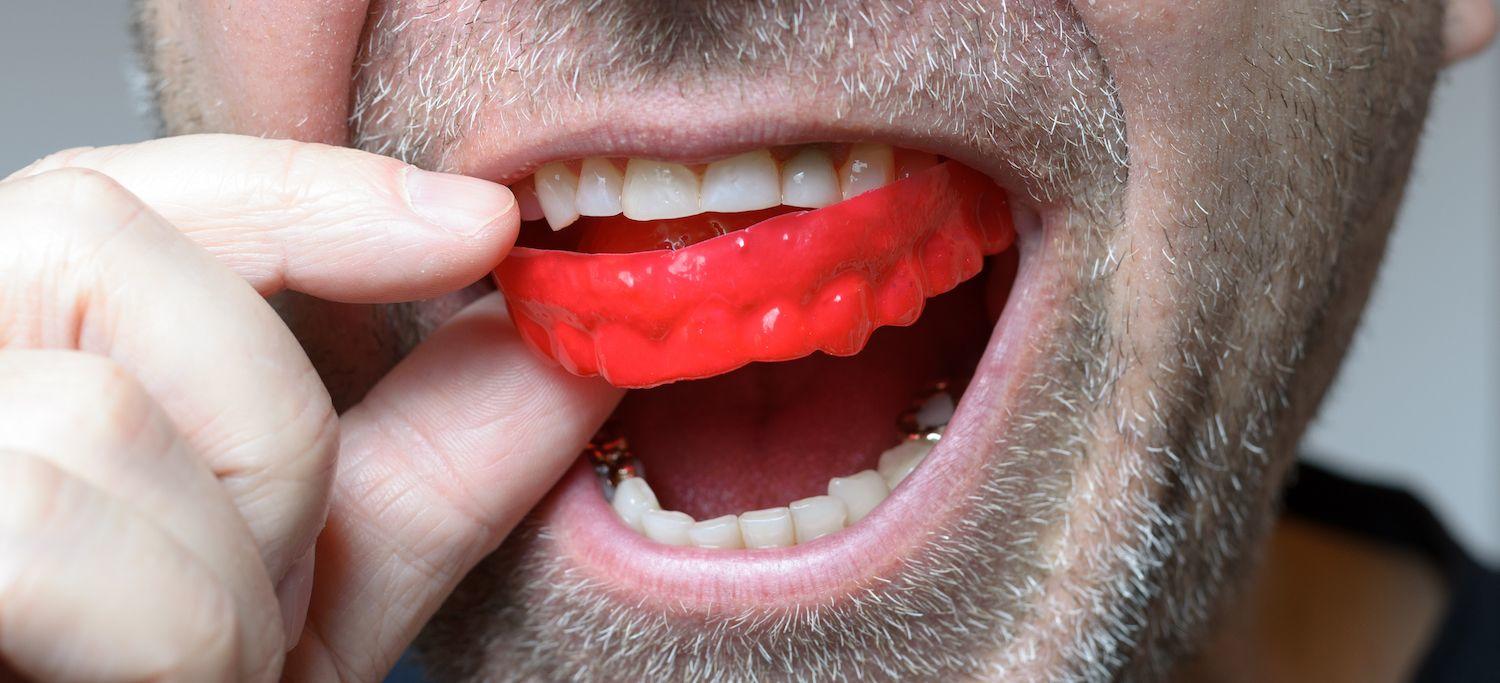 Man Wearing a Red Occlusal Appliance - Mouthguard for Bruxism