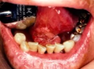 hpv positive oral cavity sqaumous cell carcinoma and oropharyngeal cancer pictures