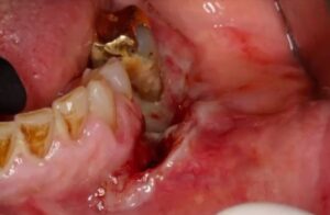 image of squamous cell carcinome involving the gingiva