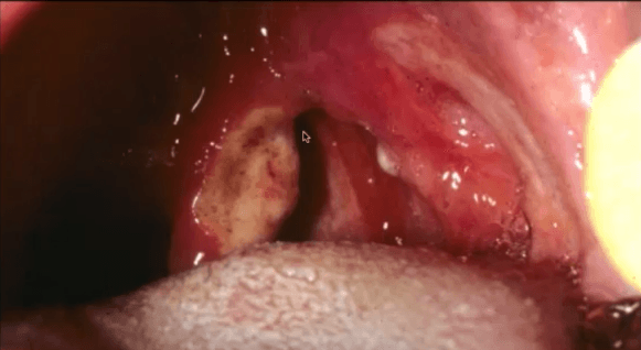 major recurrent aphthous stomatitis