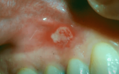 Aphthous Stomatitis: Treatment, Diagnosis, and Clinical Pictures
