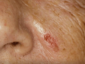 Mucocutaneous condition of Pemphigus Vulgaris localized to the skin.