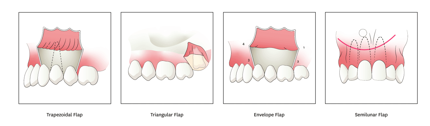Mucogingival Flap Illustrations for Jaw Bone Biopsies Including Trapezoidal, Triangular, Envelope, and Semilunar Flaps
