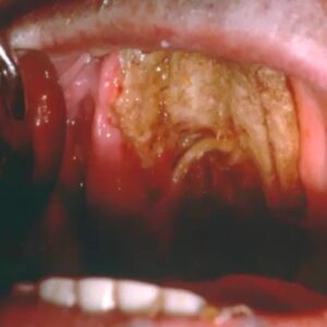 mucormycosis pictures treatment infectious lesions mouth