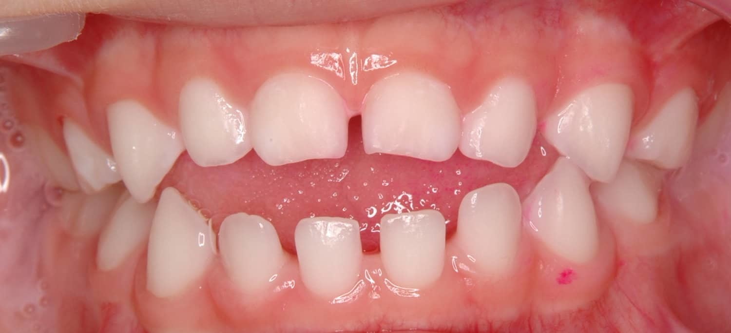 Patient with an Open Bite Malocclusion who could benefit from an Occlusal Stabilization Appliance