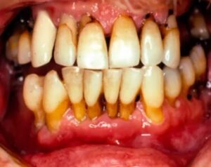 oral cancer with periodontitis opscc