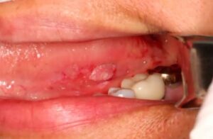 oral cavity squamous cell carcinoma along the lateral border of the tongue