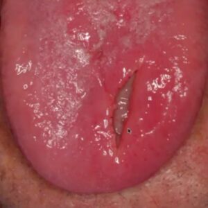 oral lesions on tongue picture oral deep fungal infection ulceration