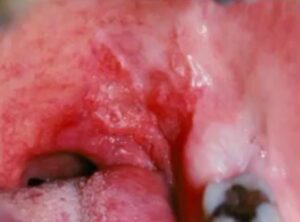 oropharyngeal cancer picture with granular erythroplakia on the tonsillar pillars