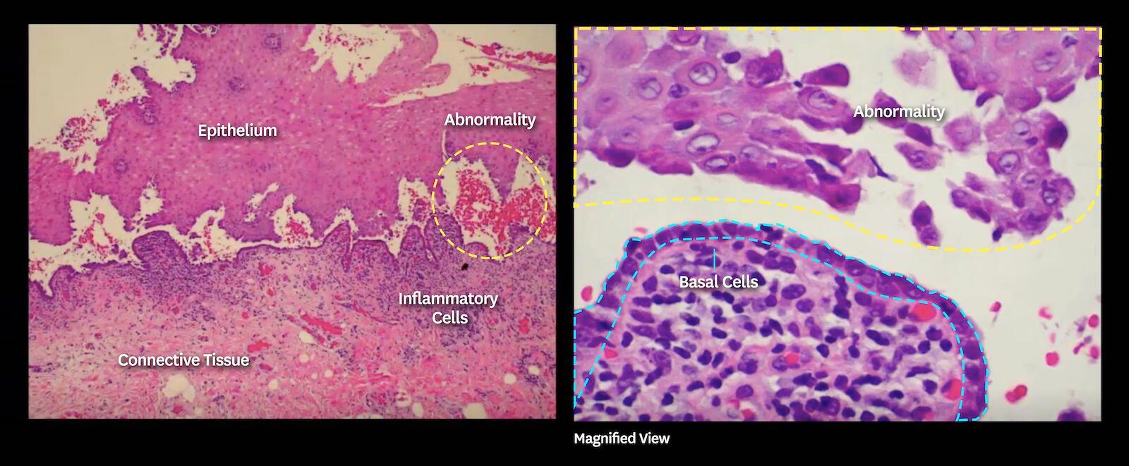 Pemphigus Vulgaris histology picture with annotations.