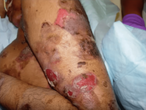Diffuse involvement of localized Pemphigus Vulgaris lesions on the arm.