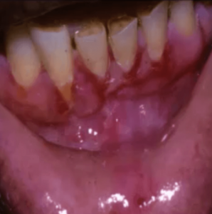 Pemphigus Vulgaris picture of oral ulcers and lesions on the gums.