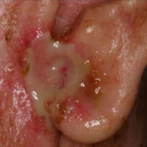 skin lesion pictures of histoplasmosis of the oral cavity