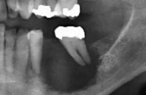 radiograph of squamous cell carcinoma picture involving the gingiva