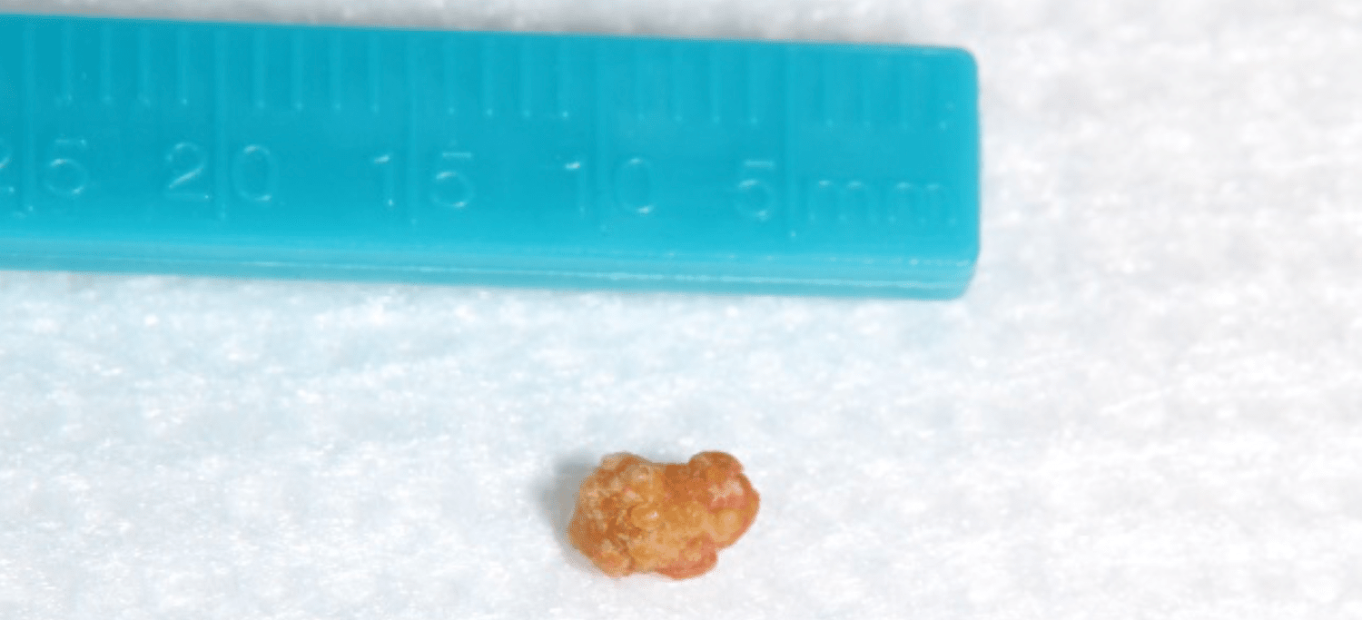 Picture of a Salivary Stone that Was Removed from a Patient's Salivary Gland