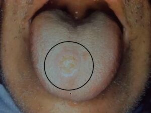 secondary syphilis mouth ulcer picture condyloma lata