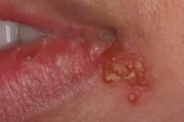 Oral Pathology of Secondary (Recurrent) Herpetic Eruptions