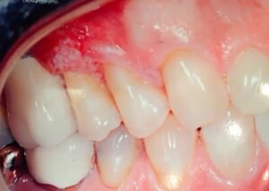 squamous cell carcinoma picture dental implant