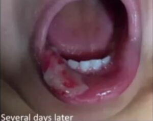 Necrotic lip from traumatic ulcerative granuloma with stromal eosinophilia.