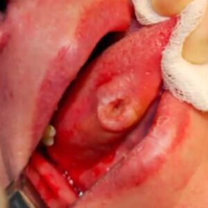 Picture of traumatic ulcerative granuloma with stromal eosinophilia (TUGSE) in the mouth.