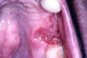 ulcerative granulomatous lesion squamous cell carcinoma of the gingiva picture